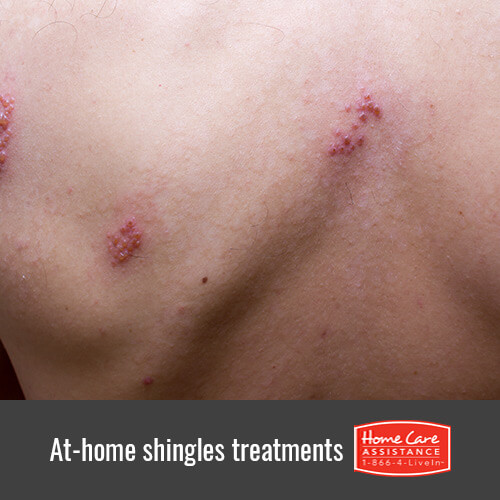 Easy At-Home Treatments to Relieve Shingles in Oshkosh, WI