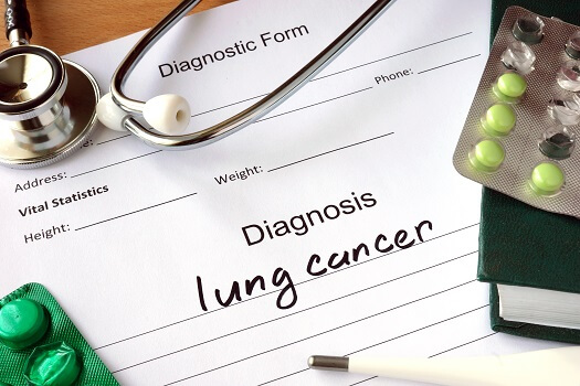 Diminishing the Risk of Lung Cancer in the Elderly in Oshkosh, WI